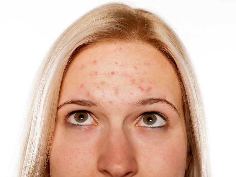 turmeric benefits for acne and acne scars